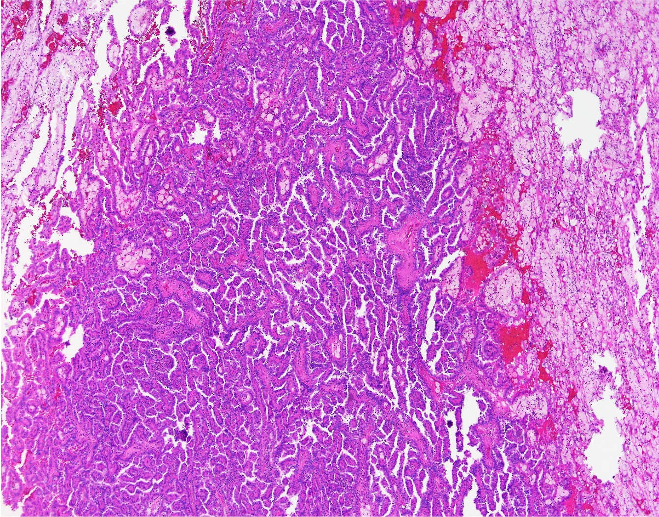 Papillary Renal Cell Carcinoma | Global Pathology Teaching And ...